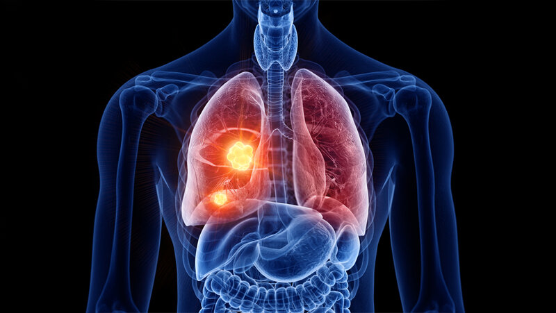 Innovative Fortschritte in der Lungenkrebsbehandlung