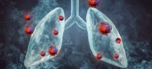 Cauze și opțiuni de tratament a cancerului de plămâni