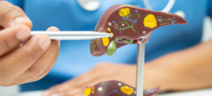 Cancerul hepatic favorizat de boala ficatului gras