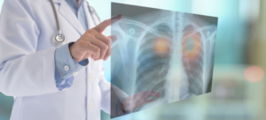 Prof. Univ. Dr. Walter Klepetko: „Renunțați la fumat. E cauza principală pentru cancer pulmonar”