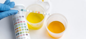 Simptomul de alarmă al cancerului de vezică urinară