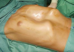 Prim. Prof. Univ. Dr. Alexander Rokitansky, specialist chirurgie pediatrică: Pieptul în pâlnie nu este o problemă pur cosmetică